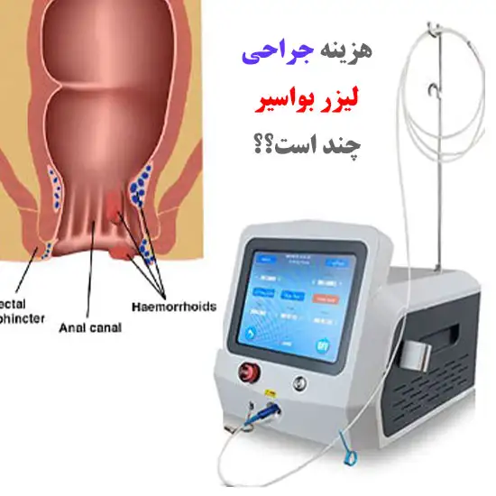 هزینه لیزر بواسیر با لیزر در شهرهای مختلف