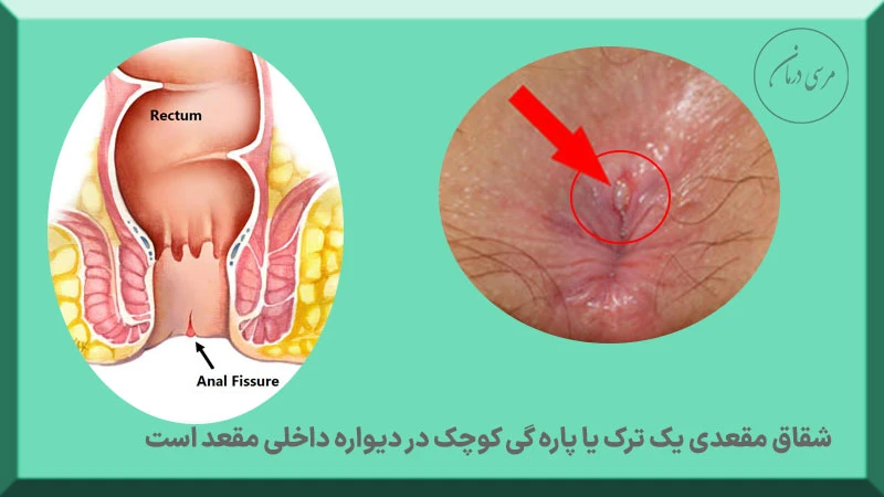 شقاق مقعدی چیست شقاق یک ترک یا چاک خوردگی دهانه مقعد است