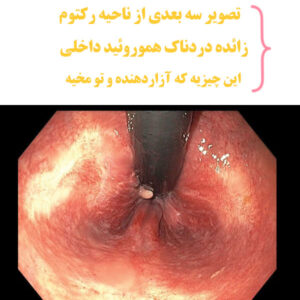 بواسیر داخلی